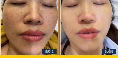 Điều trị nam tại Uyên Spa Biên Hòa